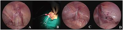 Single-Port Laparoscopic Assisted Transcrotal Orchidopexy for Palpable Inguinal Canalicular Cryptorchidism Accompany With Indirect Inguinal Hernia